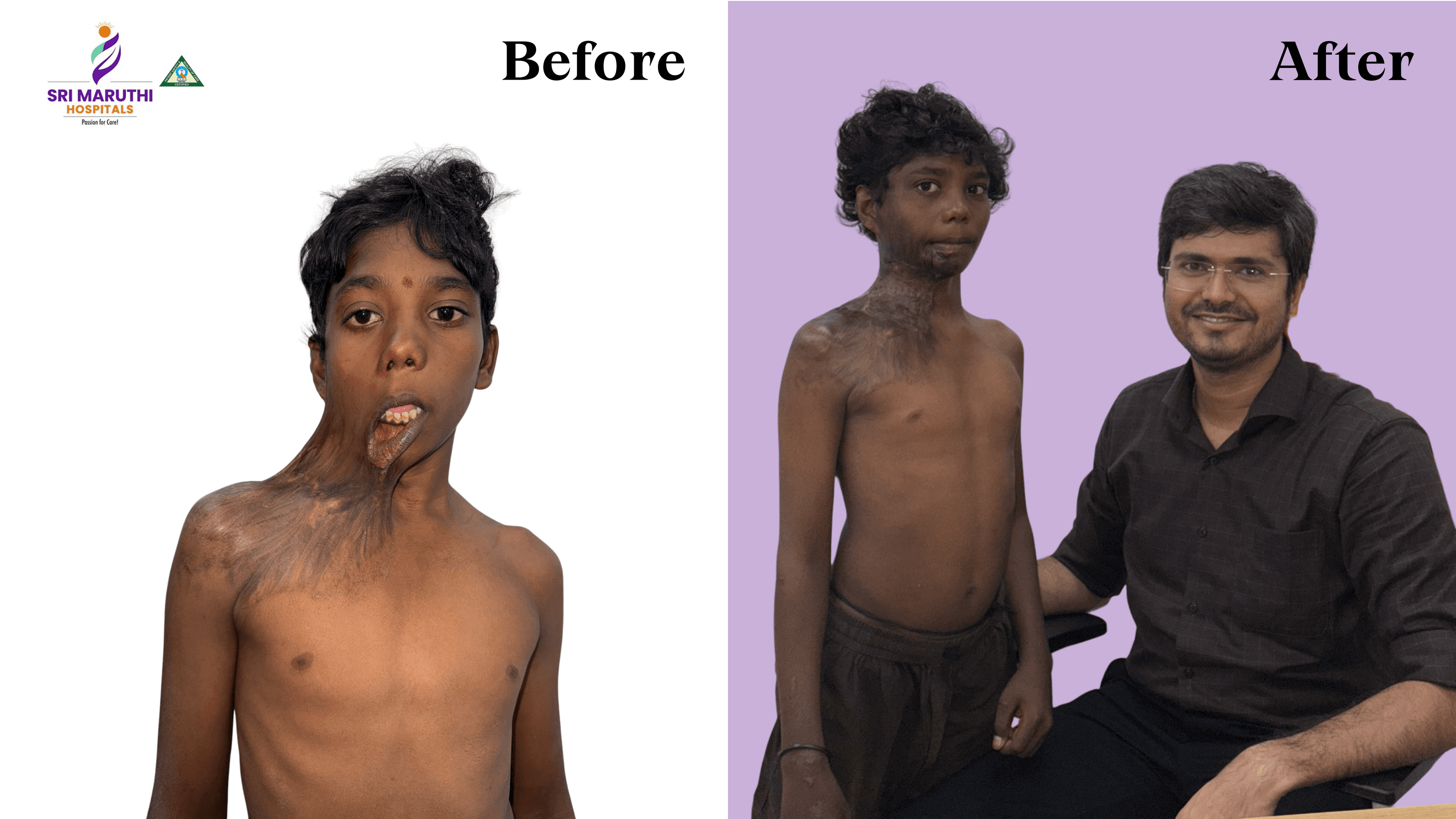 Post Burn Neck Contracture Treatment